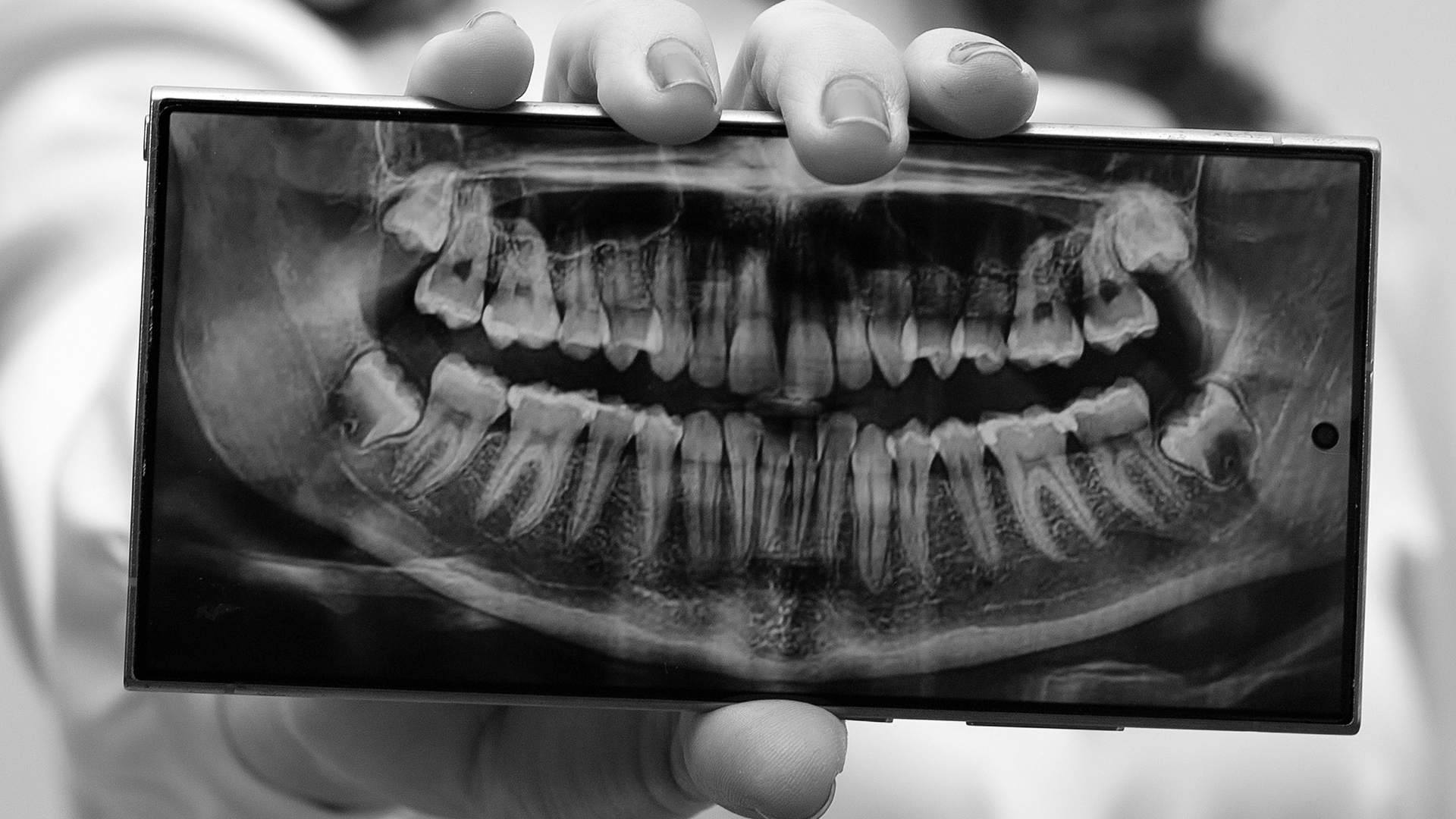 Bölcsességfog eltávolítása a MyDent fogászattal